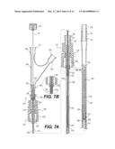 DOUBLE LUMEN OR DOUBLE WIRE ENDOBRONCHIAL ULTRASOUND-GUIDED HISTOLOGY     NEEDLE (EBUS) diagram and image