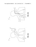 BLEEDING CONTAINMENT DEVICE diagram and image