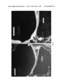 CARTILAGE REPAIR, PRESERVATION AND GROWTH BY STIMULATION OF BONE-CHONDRAL     INTERFASE AND DELIVERY SYSTEM AND METHODS THEREFOR diagram and image