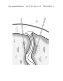 CARTILAGE REPAIR, PRESERVATION AND GROWTH BY STIMULATION OF BONE-CHONDRAL     INTERFASE AND DELIVERY SYSTEM AND METHODS THEREFOR diagram and image