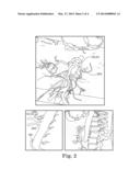 SYSTEM AND METHOD OF PRE-AORTIC GANGLION ABLATION diagram and image