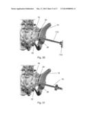 METHOD OF REPAIRING SACROILIAC FUSION diagram and image