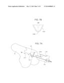 METHODS AND APPARATUS FOR PREPARING A PATIENT S FEMUR FOR PATELLOFEMORAL     KNEE ARTHROPLASTY diagram and image