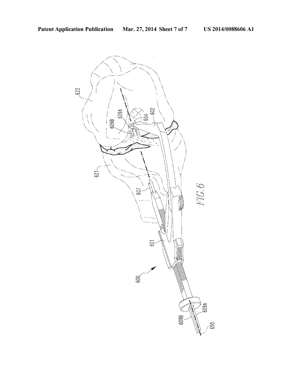 OVAL TIBIA GUIDE - diagram, schematic, and image 08