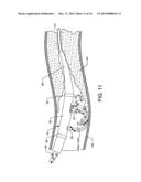 ENHANCED CROSS STREAM MECHANICAL THROMBECTOMY CATHETER diagram and image