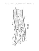 ENHANCED CROSS STREAM MECHANICAL THROMBECTOMY CATHETER diagram and image