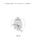 PACEMAKER diagram and image