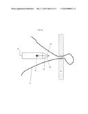 ADVANCE SUTURE PASSER diagram and image