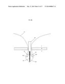 ADVANCE SUTURE PASSER diagram and image