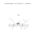 ADVANCE SUTURE PASSER diagram and image