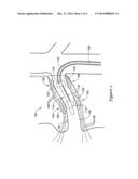 SYSTEM FOR NERVE MODULATION AND INNOCUOUS THERMAL GRADIENT NERVE BLOCK diagram and image