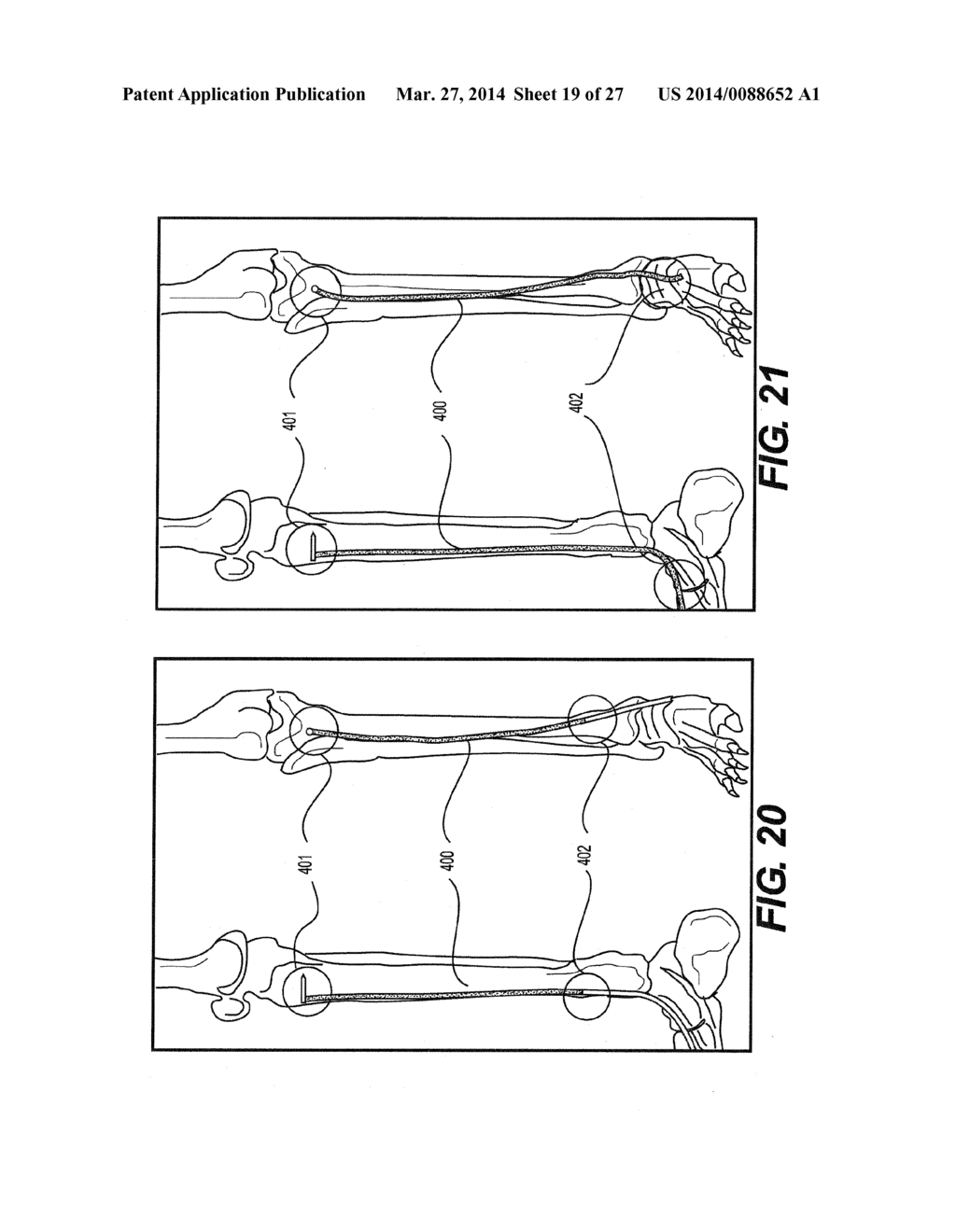 INTERNAL DYNAMIC SPLINT AND METHOD FOR USE THEREOF - diagram, schematic, and image 20
