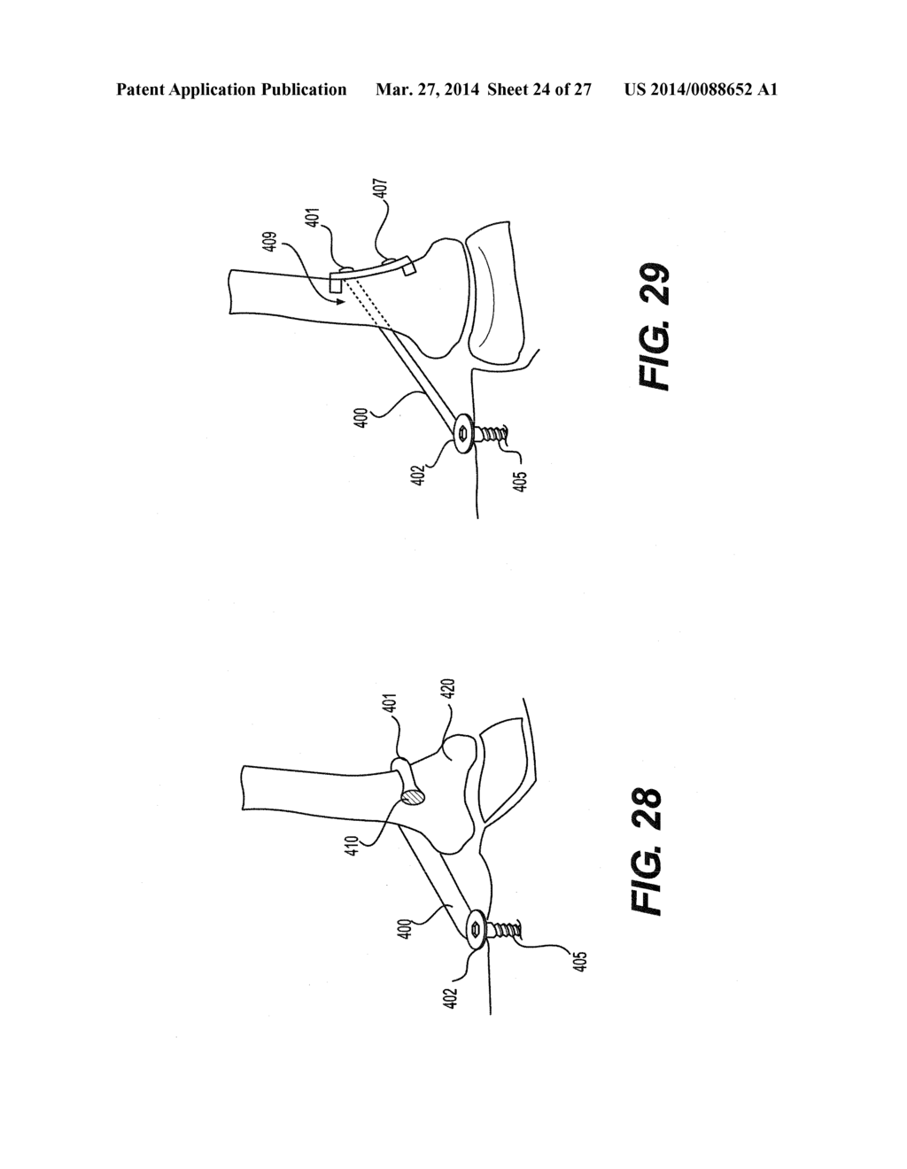 INTERNAL DYNAMIC SPLINT AND METHOD FOR USE THEREOF - diagram, schematic, and image 25