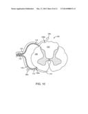 METHOD FOR EPIDURAL STIMULATION OF NEURAL STRUCTURES diagram and image