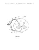 METHOD FOR EPIDURAL STIMULATION OF NEURAL STRUCTURES diagram and image