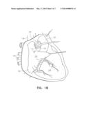 NEURAL STIMULATION SYSTEM FOR CARDIAC FAT PADS diagram and image