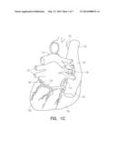 NEURAL STIMULATION SYSTEM FOR CARDIAC FAT PADS diagram and image