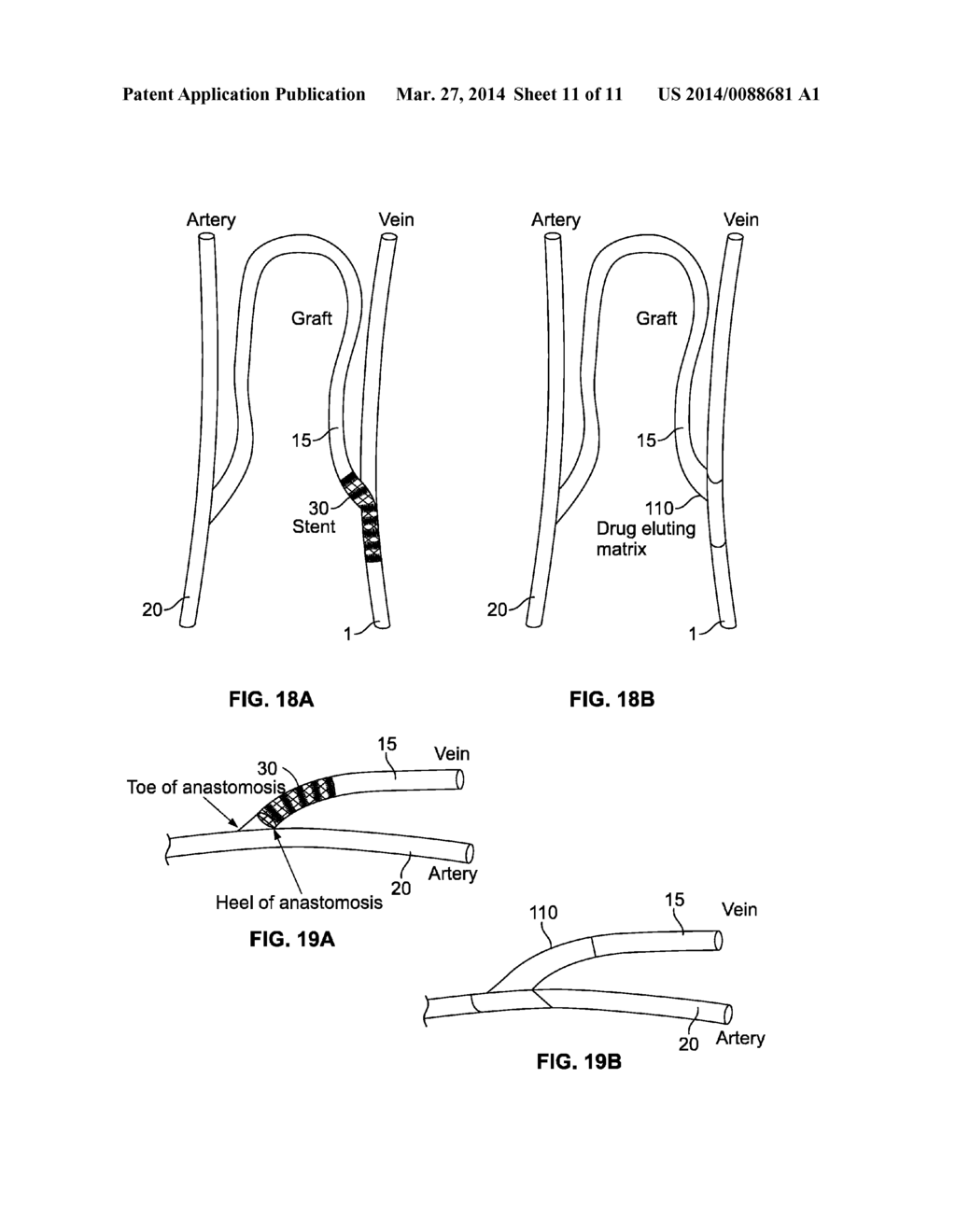 DEVICE AND METHOD FOR PREVENTING STENOSIS AT AN ANASTOMOSIS SITE - diagram, schematic, and image 12