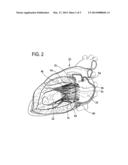 PROSTHETIC VALVE FOR REPLACING AN ATRIOVENTRICULAR HEART VALVE diagram and image