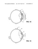 IRIS SHIELD diagram and image