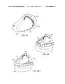 ADJUSTABLE TONGUE RETAINING ORAL APPLIANCE diagram and image