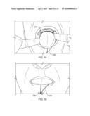 ADJUSTABLE TONGUE RETAINING ORAL APPLIANCE diagram and image