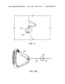 ADJUSTABLE TONGUE RETAINING ORAL APPLIANCE diagram and image