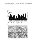 MARKER COMPRISING ANTI-CK8/18 COMPLEX AUTOANTIBODY AND ITS USE FOR     DIAGNOSING CANCER diagram and image