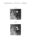 ACCOUNTING FOR SKIPPED IMAGING LOCATIONS DURING MOVEMENT OF AN ENDOLUMINAL     IMAGING PROBE diagram and image