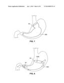 SATIATION DEVICES AND METHODS diagram and image