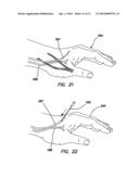 SYSTEMS AND METHODS FOR CREATING ARTERIOVENOUS (AV) FISTULAS diagram and image