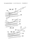 SYSTEMS AND METHODS FOR CREATING ARTERIOVENOUS (AV) FISTULAS diagram and image