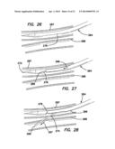 SYSTEMS AND METHODS FOR CREATING ARTERIOVENOUS (AV) FISTULAS diagram and image