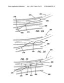 SYSTEMS AND METHODS FOR CREATING ARTERIOVENOUS (AV) FISTULAS diagram and image