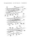 SYSTEMS AND METHODS FOR CREATING ARTERIOVENOUS (AV) FISTULAS diagram and image