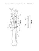 Surgical Guide with Cut Resistant Inserts diagram and image