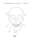 Surgical Guide with Cut Resistant Inserts diagram and image