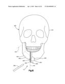 Surgical Guide with Cut Resistant Inserts diagram and image