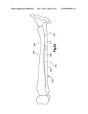 Surgical Guide with Cut Resistant Inserts diagram and image