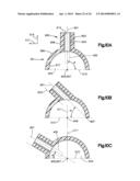 Surgical Guide with Cut Resistant Inserts diagram and image