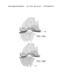 PATIENT-MATCHED INSTRUMENTS diagram and image