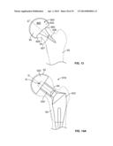 Patient-Specific Shoulder Guide diagram and image