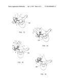 VERTEBRAL OSTEOSYNTHESIS EQUIPMENT diagram and image