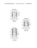 Spinal Stabilization Device diagram and image