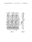 Retrievable Heart Valve Anchor and Method diagram and image