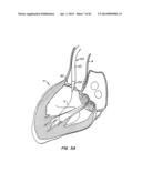 Retrievable Heart Valve Anchor and Method diagram and image