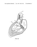 Retrievable Heart Valve Anchor and Method diagram and image