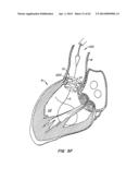 Retrievable Heart Valve Anchor and Method diagram and image