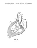 Retrievable Heart Valve Anchor and Method diagram and image