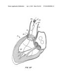 Retrievable Heart Valve Anchor and Method diagram and image